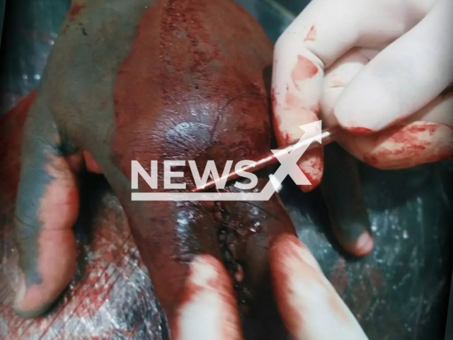 Picture shows the fingers of Michel Praddo, better known as 'Diabao',  being sewn together during  the modification,  undated. He revealed that he underwent a new body modification to join his index and middle fingers. Note: Private photo. (@michel.praddo/newsflash)