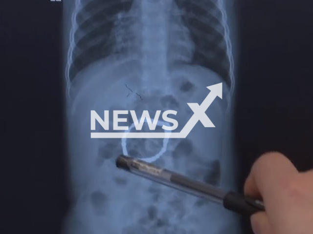 A two-year-old boy swallowed 32 magnetic beads in Changsha, China. Note: Image is a screenshot from video. (AsiaWire)