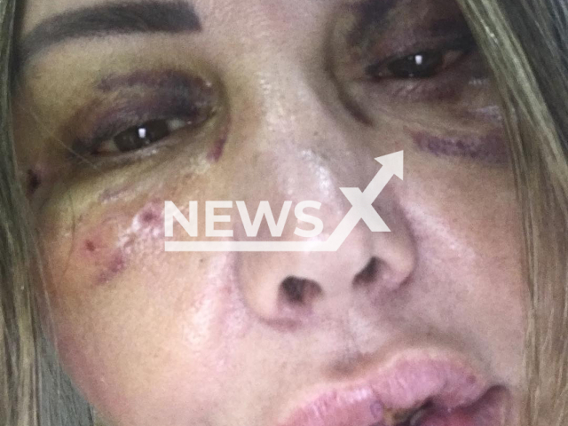 Picture shows the injuries of Elaine Caparroz after the attack, undated. The court revoked the arrest of her attacker Vinicius Batista Serra and replaced it with other measures in Rio de Janeiro, Brazil, on Monday, Oct. 31, 2022.  
Note: Private photo.  (@elaine.caparroz/Newsflash)