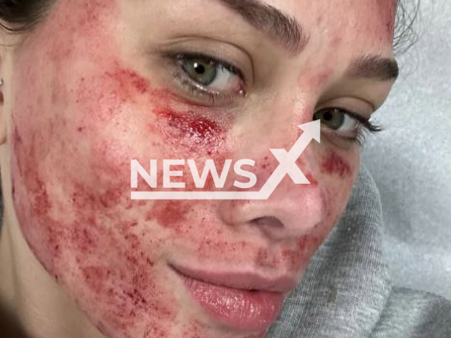 Flavia Pavanelli, 24,  shows her bleeding face, after a laser cosmetic procedure, on Monday, Nov. 7, 2022.   The procedures used lights and lasers to improve the skin's vitality and the appearance of blemishes.  
 Note: Private photo.  (@flaviapavanelli/Newsflash)