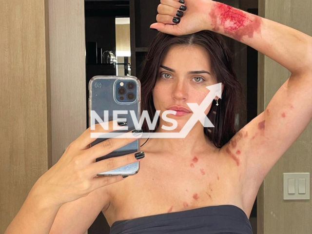 Photo shows the injuries of Eva Carolina Quattrocci, better known as Eva De Dominici, poses in an undated photo. She is an Argentine model and actress was born in Avellaneda, Buenos Aires, Argentina. Note: Picture is private (@dedominicieva/Newsflash)