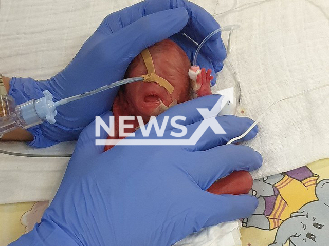 Image shows little Leonie shortly after her birth, undated photo. She weighed only 350 grams (0.8 lbs) when she was born in July 2022. Note: Licensed content. (Helios Klinikum Hildesheim/Newsflash)