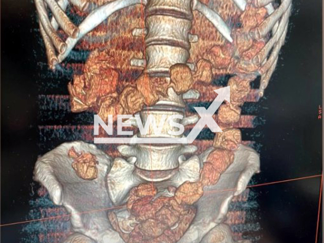 Picture shows X-ray scan results of unnamed man, 25, at Pulkovo airport, St. Petersburg, Russia in undated footage. The man delivered 1 kg of cocaine from Brazil hidden in his gastrointestinal tract. Note: Picture is obtained from the Federal Customs Service of Russia (@customs_rf/Newsflash)