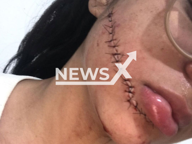 Picture shows the stiches on the  cut on the face of  Stefani Firmo, 23, undated. Her face cut while she was sleeping during a bus trip from Recife  to Salvador, Brazil,   Tuesday, Nov. 29, 2022.
Note: Private photo.  (@teffi_nh/Newsflash)