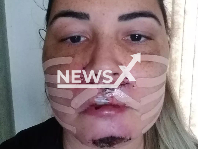 Picture shows the scarred face of Brazilian influencer Mariana Michelini, 34, undated. She filed a lawsuit against a  dentist who  injected her with a harmful product  in Matao, Brazil, in 2020, causing her to need to have face reconstructing procedures.
Note: Private photo.  (@mari_michelini/Newsflash)