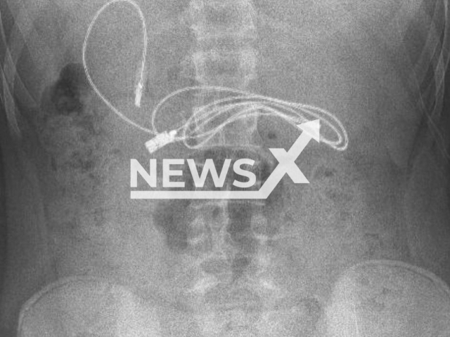 Photo shows an x-ray image of a 15-year-old male patient, undated photo. A charging cable and a hair tie were removed from his stomach at a hospital in Diyarbakir, Turkey. Note: Picture is private (@prof.dr.yasardogan/Newsflash)