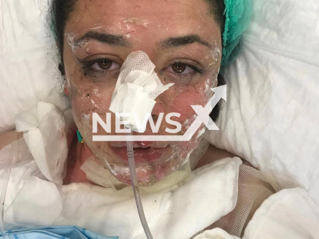 Photo shows Gizem Elif Turk after she received serious burns to her face and body during a fire, undated photo. The fire broke out at a hospital in Zonguldak, Turkey, Dec. 10, 2021. Note: Picture is private (@gizemelifturk/Newsflash)