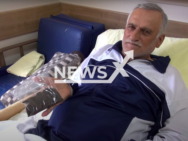 Kemal Dogru, 64, posed with the gallstones that were removed from his gallbladder by Dr Vahit Mutlu in Tokat, Turkey on 26th February 2022. Note: Picture is a screenshot from a video (Newsflash)