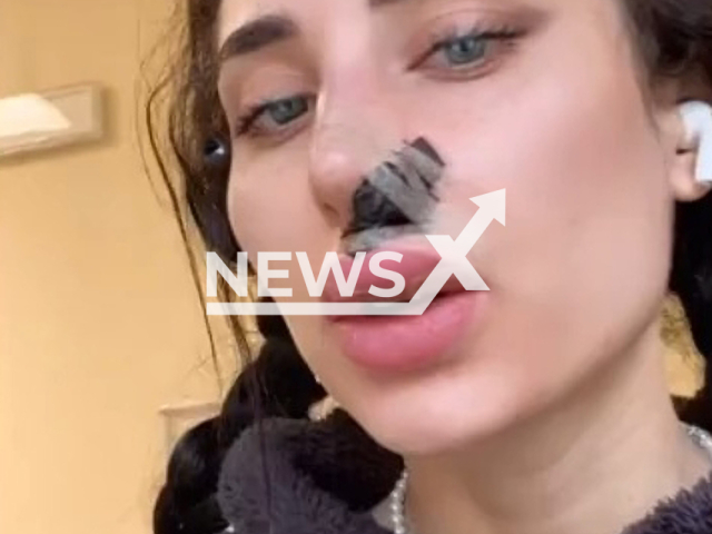 Picture shows the injuries to the face of Greta Menchi, undated. She was  attacked by a dog, in Rome, Italy, on Tuesday, Dec. 27, 2022. Note: Picture is a screenshot from a video (@gretamenchi/Newsflash)