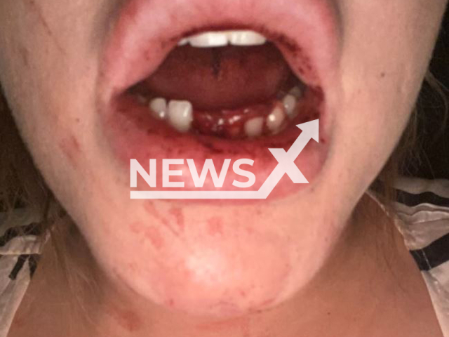 The injuries of Tessa Schimschar, 28, after former fiance, boxer Tom Schwarz, 27, allegedly attacked her in May, 2020.
Note: Private photo. (Newsflash)