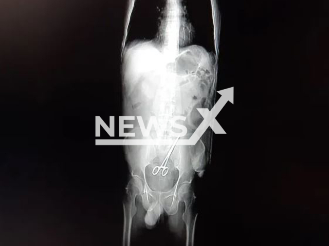 An X-ray shows scissors forgotten inside councillor Cleyton Jose Zanatta, undated. He was  was admitted to the hospital  for the removal of a pair of scissors forgotten inside his abdomen, days after undergo surgery in Colier, Brazil, Jan. 26, 2023.
Note: Private photo.  (Newsflash)