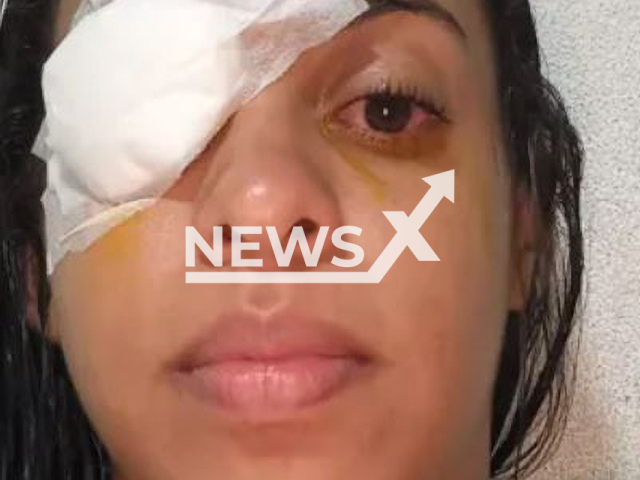 Picture shows  Mayara Santana one of the injured women, undated.  A  total of 68 people were treated for ophthalmological injuries  by hair products,  in Recife, Brazil, between Sunday and Monday, Feb. 5 and 6, 2023.
Note: Private photo. ( Mayara Santana/Newsflash)