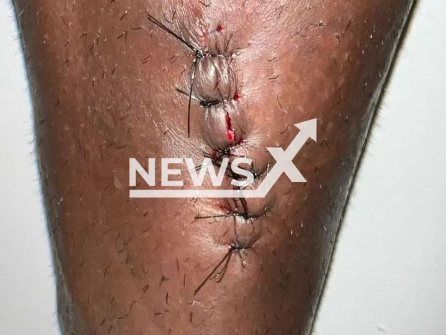 Picture shows the injury on Nikao, undated. The Cruzeiro Striker was injured during a game between  Cruzeiro and Atletico, in Belo Horizonte, Brazil,  on Monday, Feb. 13, 2023.
Note: Private photo. (@nikao10/Newsflash)