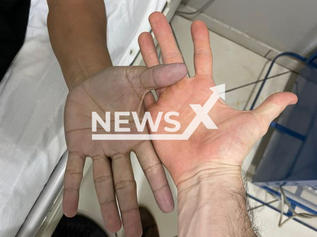 Picture shows the hand of a patient that went to the emergency room because he had blue hands and the doctor, undated. The doctor's diagnosis was the new jeans of the patient and constantly using alcohol to clean his hands, and the treatment was ro wash his hands.
Note: Private photo. (@AleGinzo_MD/Newsflash)