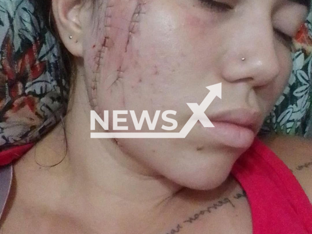 Picture shows the injuries of Daiana Matos, 23,  undated. She was attacked  by her ex-boyfriend in February, 2023, and  received 110 stitches for her injuries, 100 on her face alone.
Note: Private photo. (@bari_dadaiana/Newsflash)