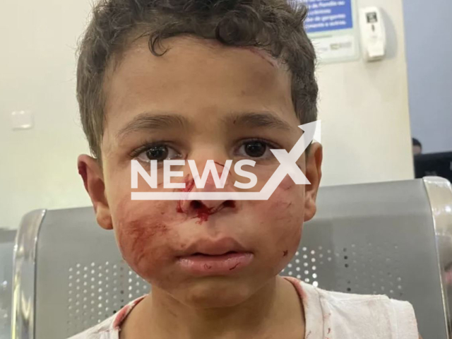 Picture shows the injury on Lucas Santos de Moura, 5, undated. A pit bull ran from its house invaded several houses attacked a dog and the boy, in Goianesia, Brazil, on Saturday, March, 4, 2023. Note: Private photo.  (Newsflash)