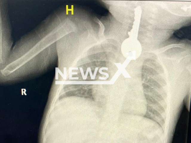 Photo shows the x-ray image of a child, undated. A child was reportedly operated on after swallowing a key in Taif, Saudi Arabia. Note: Picture is private (@taifhealth/Newsflash)