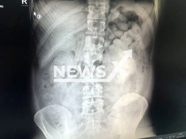 Photo shows an x-ray image, undated. The x-ray image reportedly belongs to a man who had heroin capsules in his stomach and was arrested in Diyarbakir, Turkey. Note: Picture is private (Newsflash)