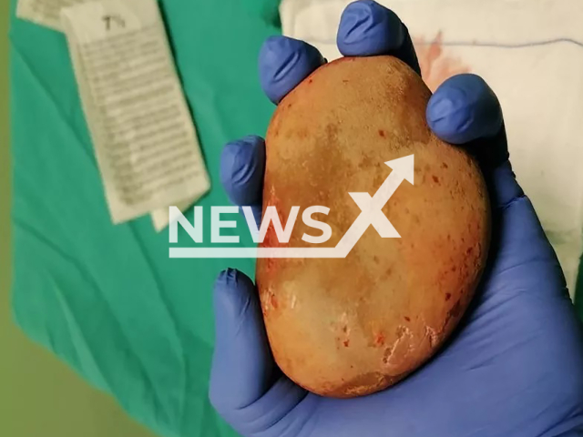 The large potato-shaped stone that was surgically removed from a patient's bladder in Ordu, Turkey. Note: Private picture (Newsflash)