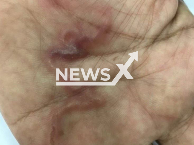 Picture shows   parasitic worms moving under human skin, undated. An unidentified woman, 58, was infested with parasitic worms after she habitually consumed raw blood pudding, in An Binh commune, Vietnam. 
 Note: Private photo.  (Newsflash)