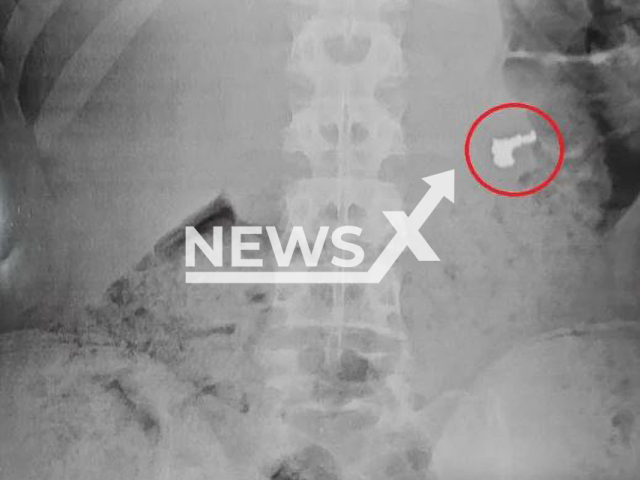 Picture shows the X-rays, showing  the gold chain was in the suspect's stomach, undated. A teenager swallowed a stolen gold chain to avoid being apprehended in the act, in Guaruja, Brazil.
 Note: Private photo.  (Newsflash)