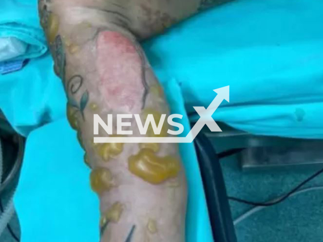 Picture shows the injuries  of DJ Juliana Maddeira, 28,    in undated photo. She had 10  per cent of her body burned after an accident with a fondue pot in June 2022, and was hospitalized for 40 days and had to undergo for 21 surgeries.
 Note: Private photo.  (Newsflash)