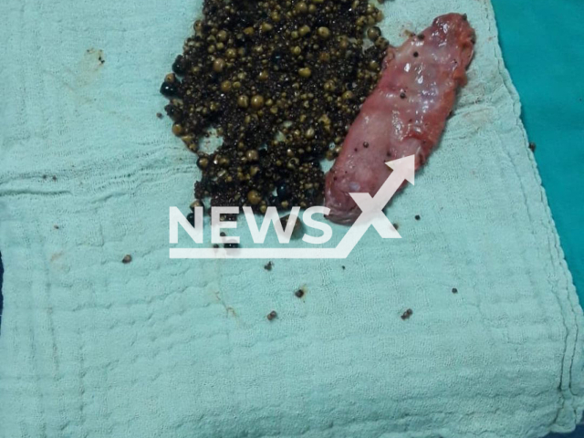 Photo shows gallstones taken out of the gallbladder of a female patient in Siirt, Turkey, undated. About 2000 gallstones were removed from the patient's gallbladder. Note: Picture is private (@siirthayathastanesi/Newsflash)