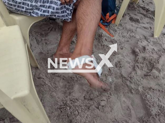 Picture  shows the injury on one of the victims, undated. At least eight people were injured after being attacked by piranhas in a beach resort in  Manaus, Brazil,  Monday, May 1, 2023.
 Note: Private photo.  (Newsflash)