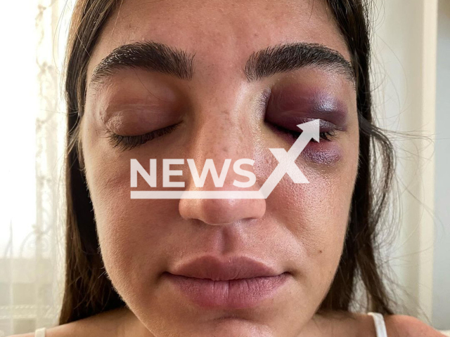 Model Gizem Akbas was battered by her ex-boyfriend Mucahit Ismail Ayta, after an argument between them in Istanbul, Turkey on 16th July 2021. Note: Private picture (@gizemakbaass/Newsflash)