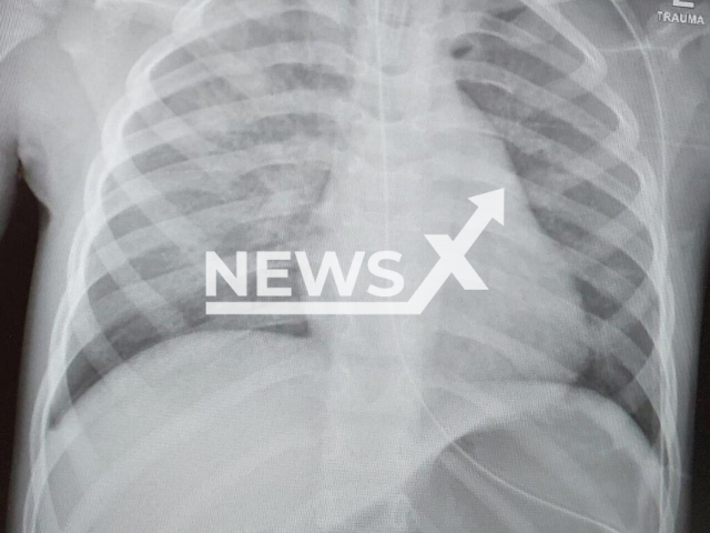 Photo shows the x-ray image of a child whose lungs swelled, undated. A six-year-old boy has been hospitalized at Assuta Ashdod Hospital in Ashdod, Israel, since Saturday, May 13, 2023, in serious condition, after choking on jelly beans. Note: Picture is private (Newsflash)