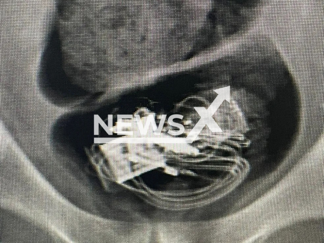 Picture shows an X-ray of a man who swallowed items to take them into the Francisco Beltrão Public Prison, in southwest Paraná, Brazil. He 'forced' his own arrest. Note: Police photo. (Policia Civil/Newsflash)